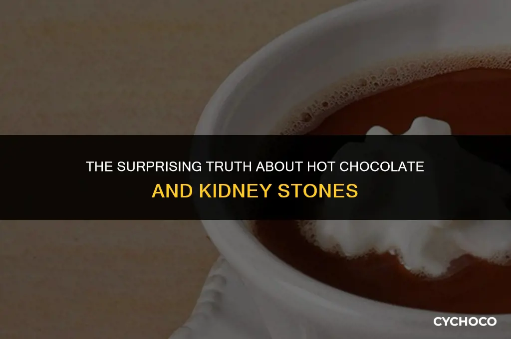 can hot chocolate cause kidney stones