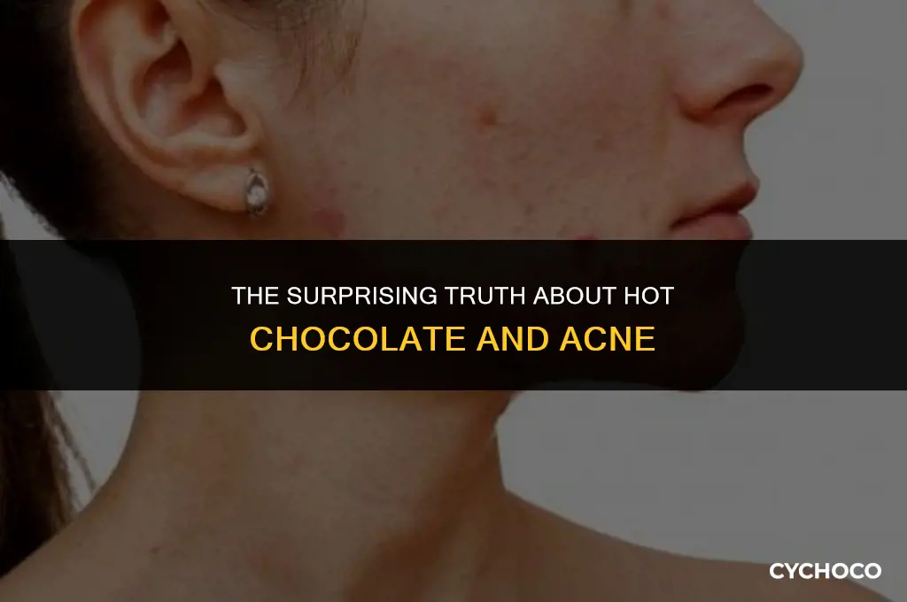 can hot chocolate give you spots