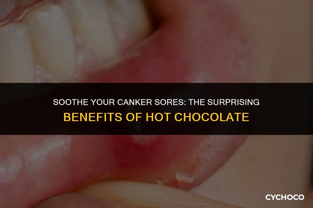 can hot chocolate help with canker sores