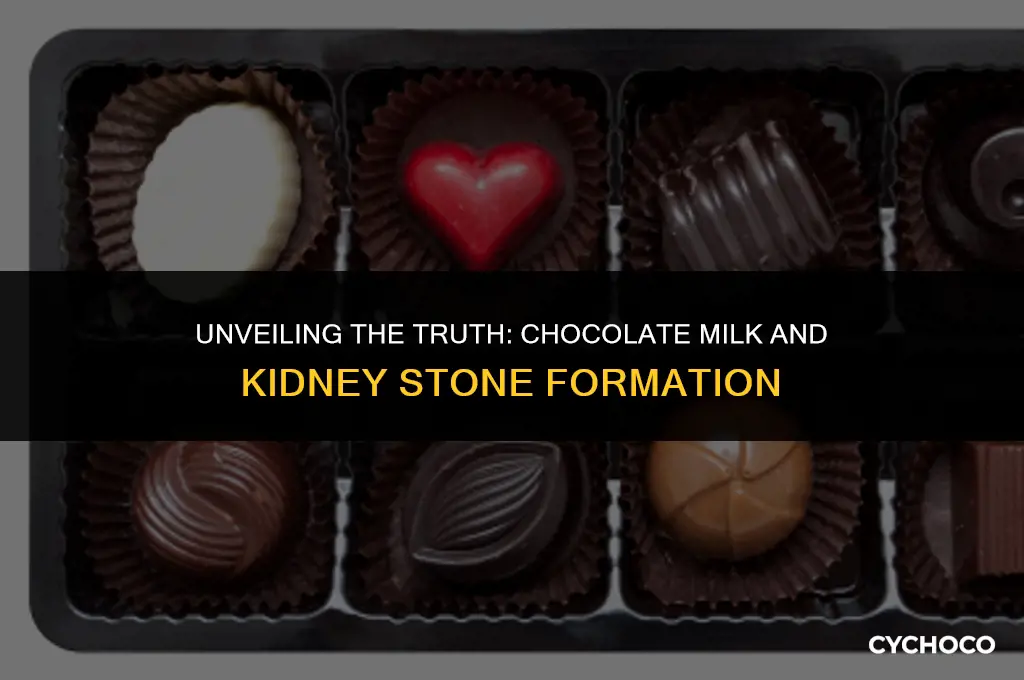 does chocolate milk cause kidney stones