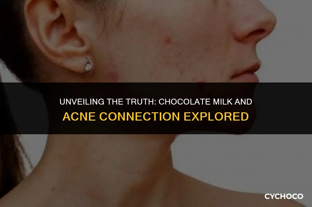 does chocolate milk give you acne