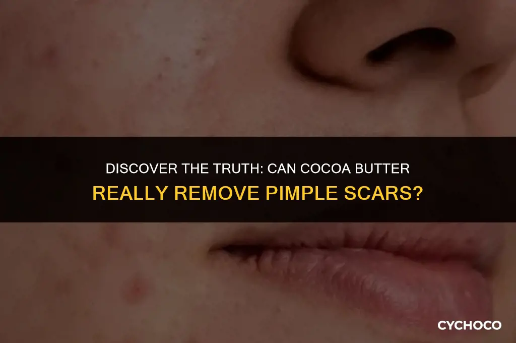 does cocoa butter remove pimple scars