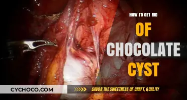 Say Goodbye to Chocolate Cysts: A Comprehensive Guide