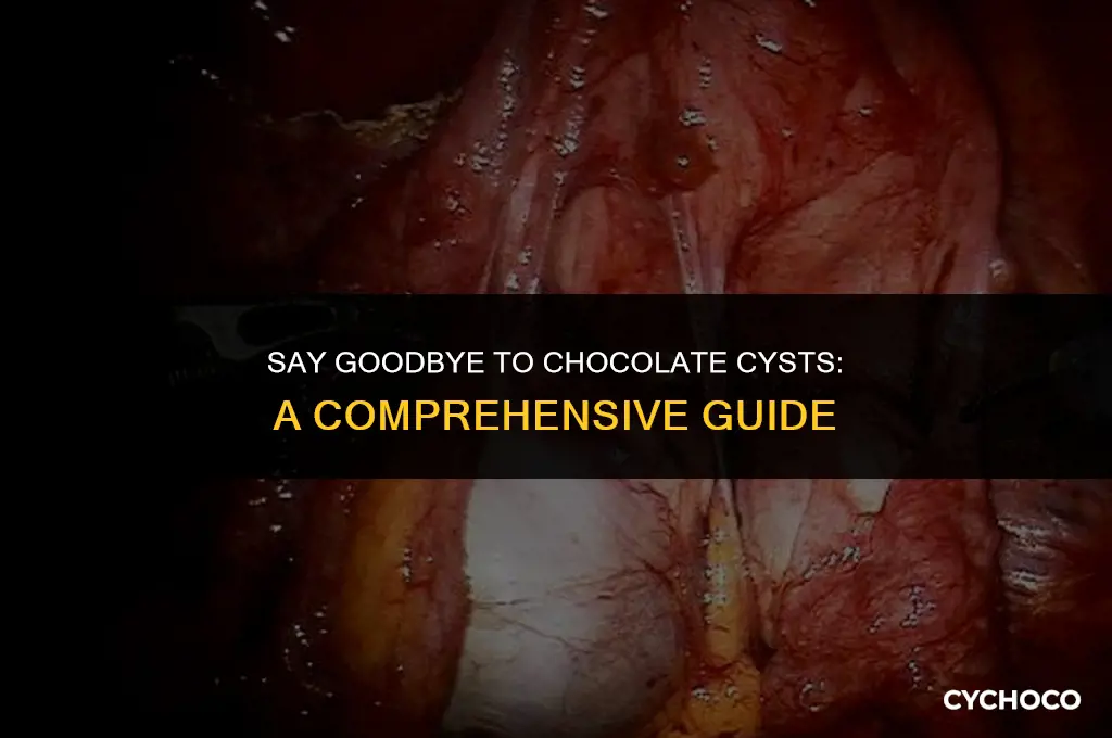 how to get rid of chocolate cyst