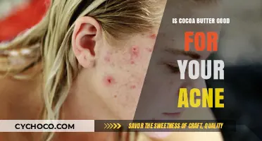 Discover the Truth: Cocoa Butter's Impact on Acne-Prone Skin