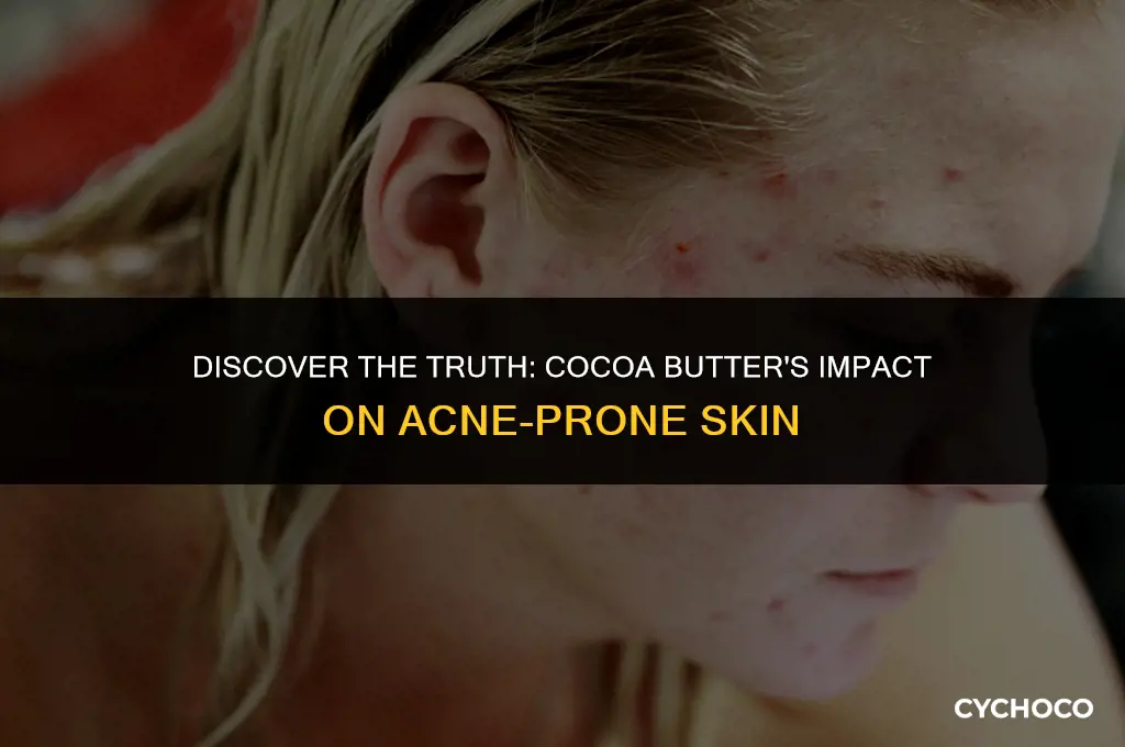 is cocoa butter good for your acne