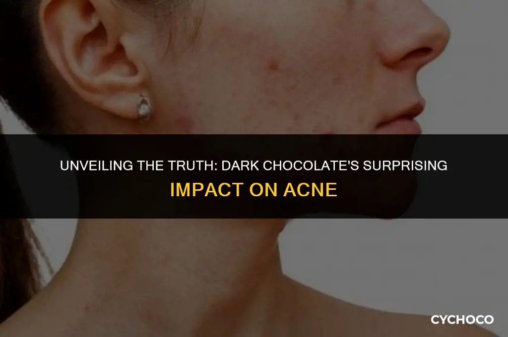 is dark chocolate good for acne